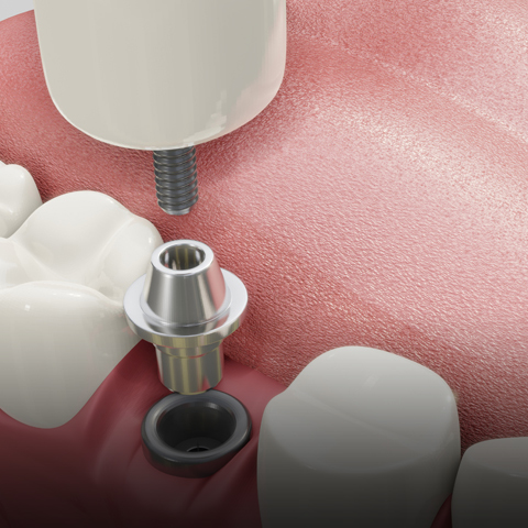 임플란트(정밀 진단·수술)